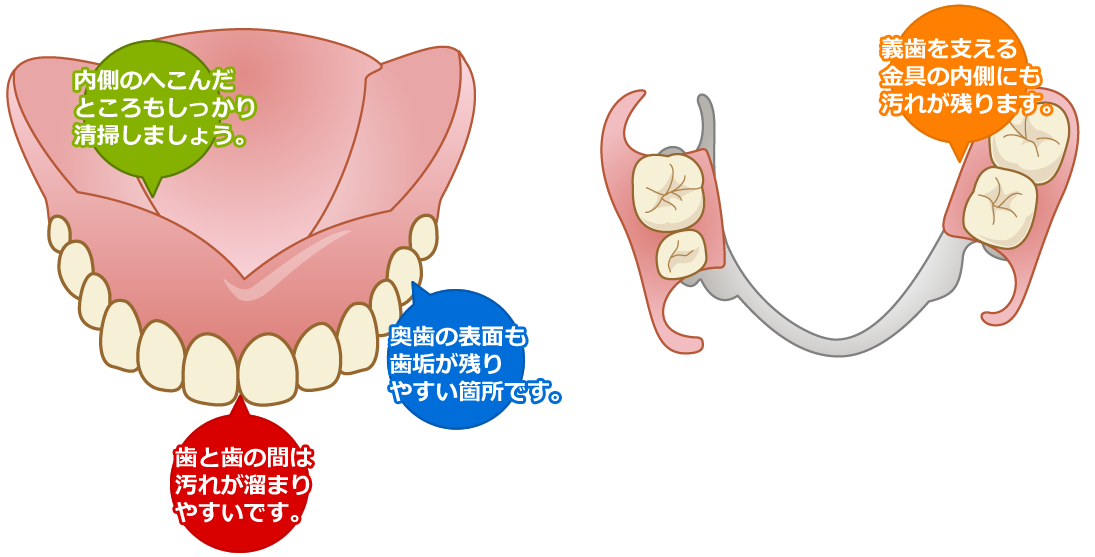 入れ歯清掃のポイント